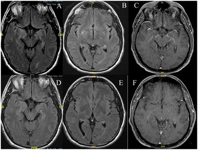 Case report: Headache as the sole neurological symptom in autoimmune glial fibrillary acidic protein (GFAP) astrocytopathy